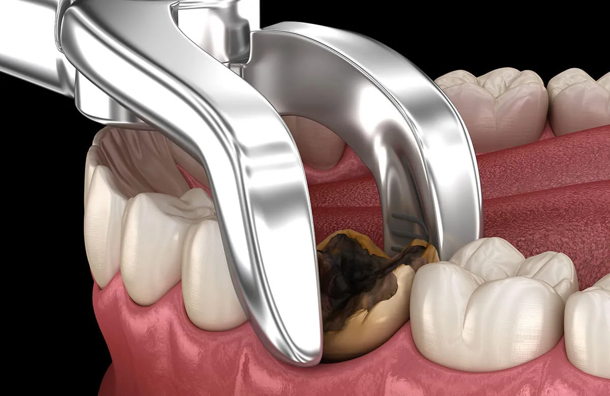 Nhổ răng và trồng răng implant