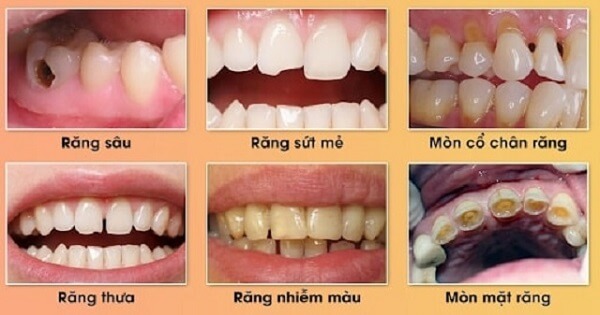 Các trường hợp nên trám răng thẩm mỹ