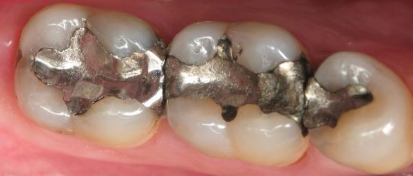 Trám răng bằng Amalgam