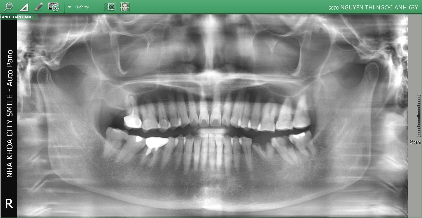 Đừng để răng khôn đau nhức hay mất răng ảnh hưởng đến chất lượng cuộc sống của bạn 3