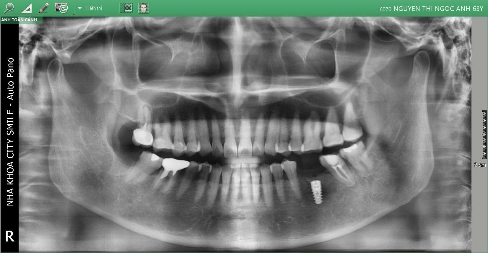 Hình ảnh chụp phim sau khi nhổ răng và cấy implant
