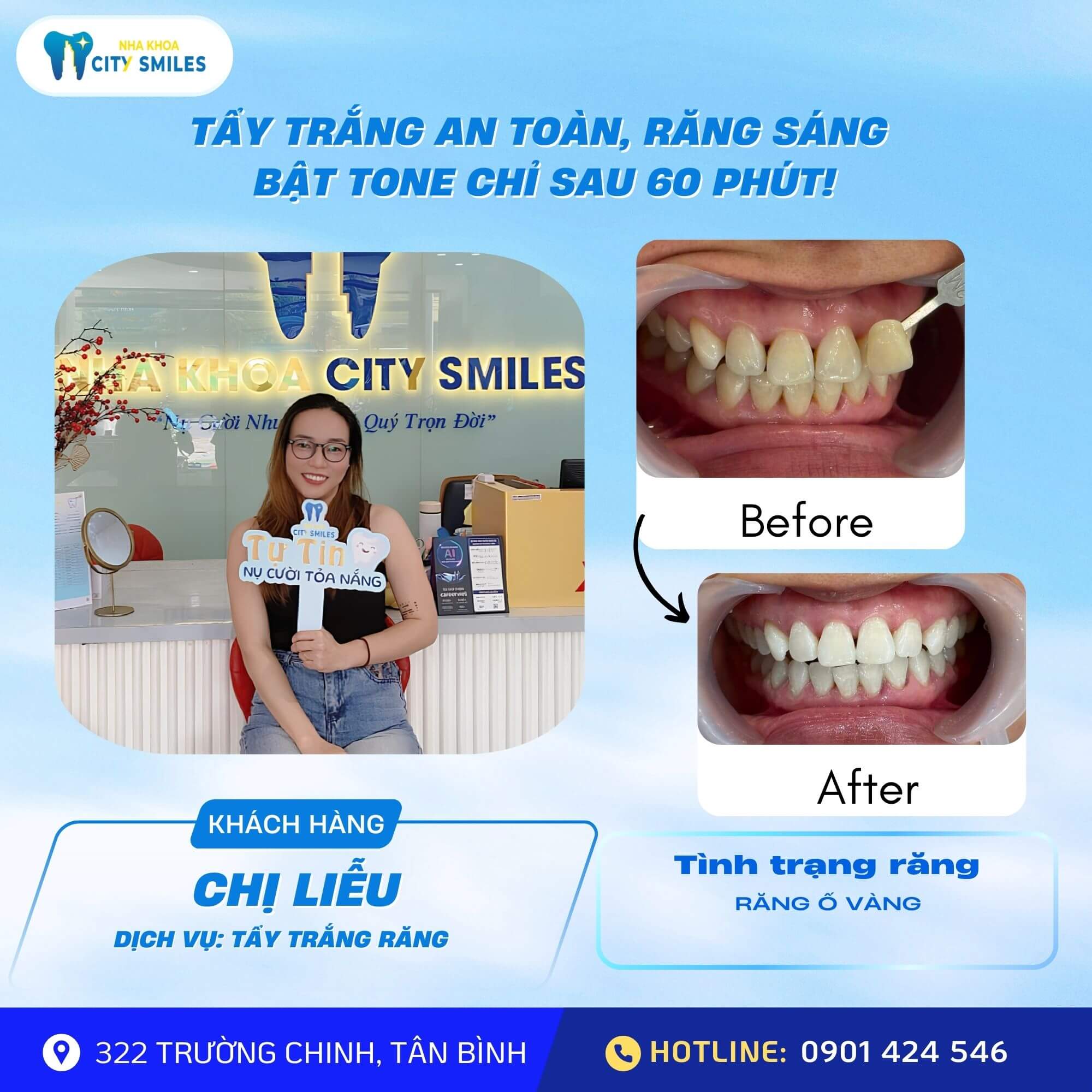 TẨY TRẮNG RĂNG – GIẢI PHÁP LẤY LẠI NỤ CƯỜI TỰ TIN CHỈ SAU 1 BUỔI 3