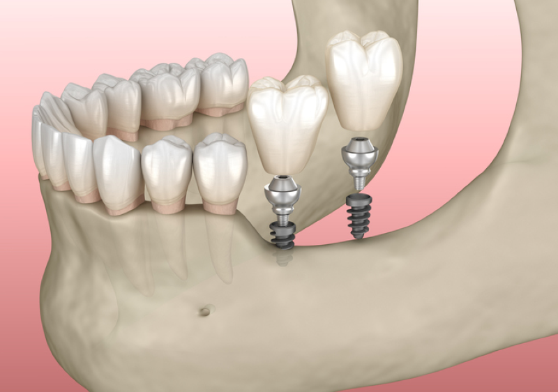 Implant mini là giải pháp tiết kiệm cho bệnh nhân