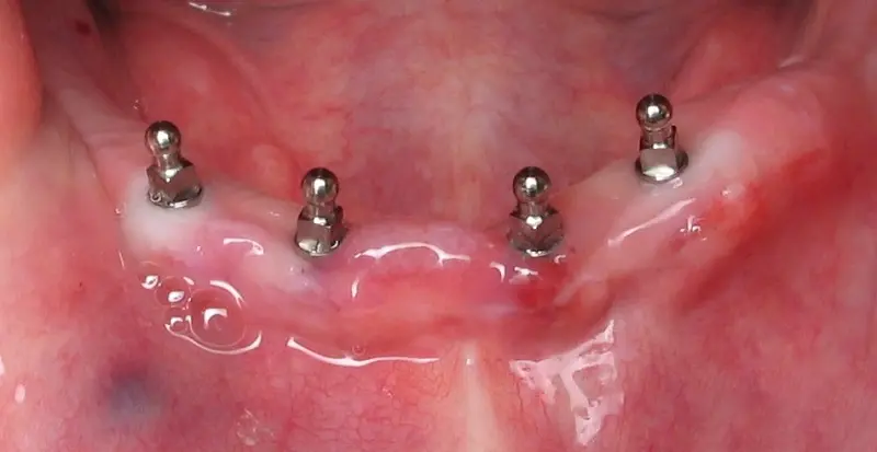 Khách hàng cấy ghép implant mini