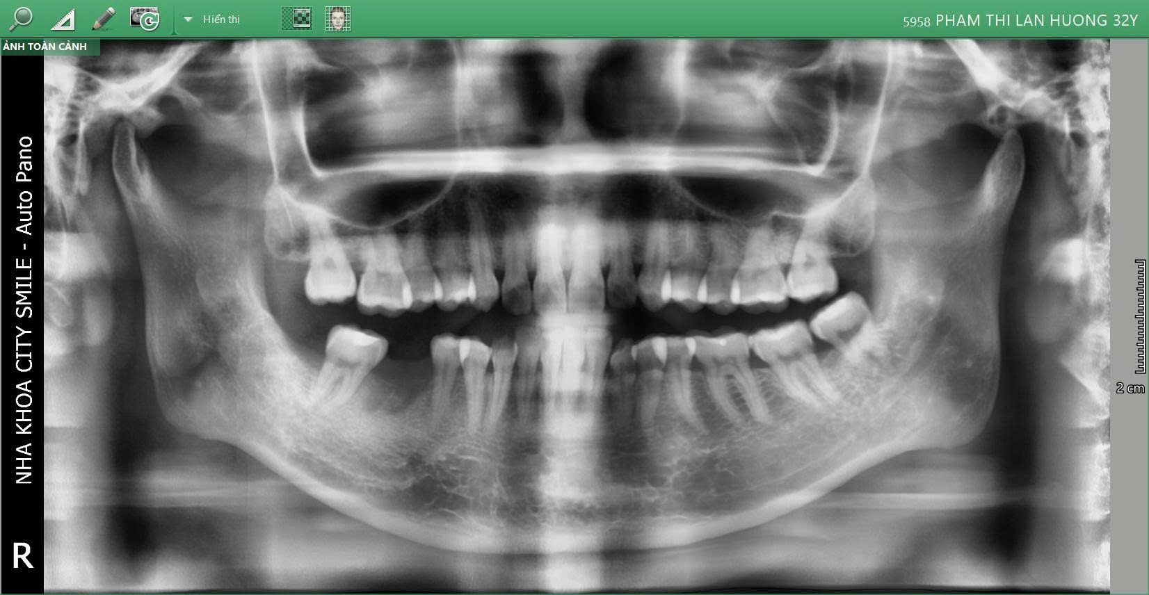 Khôi phục răng mất – Tự tin ăn nhai và nụ cười rạng rỡ 3 Hình ảnh chụp phim trước khi cắm Implant