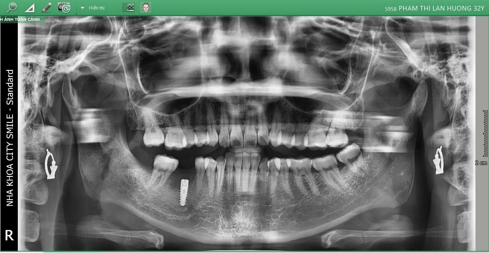 Khôi phục răng mất – Tự tin ăn nhai và nụ cười rạng rỡ 4 Hình ảnh chụp phim sau khi cắm Implant