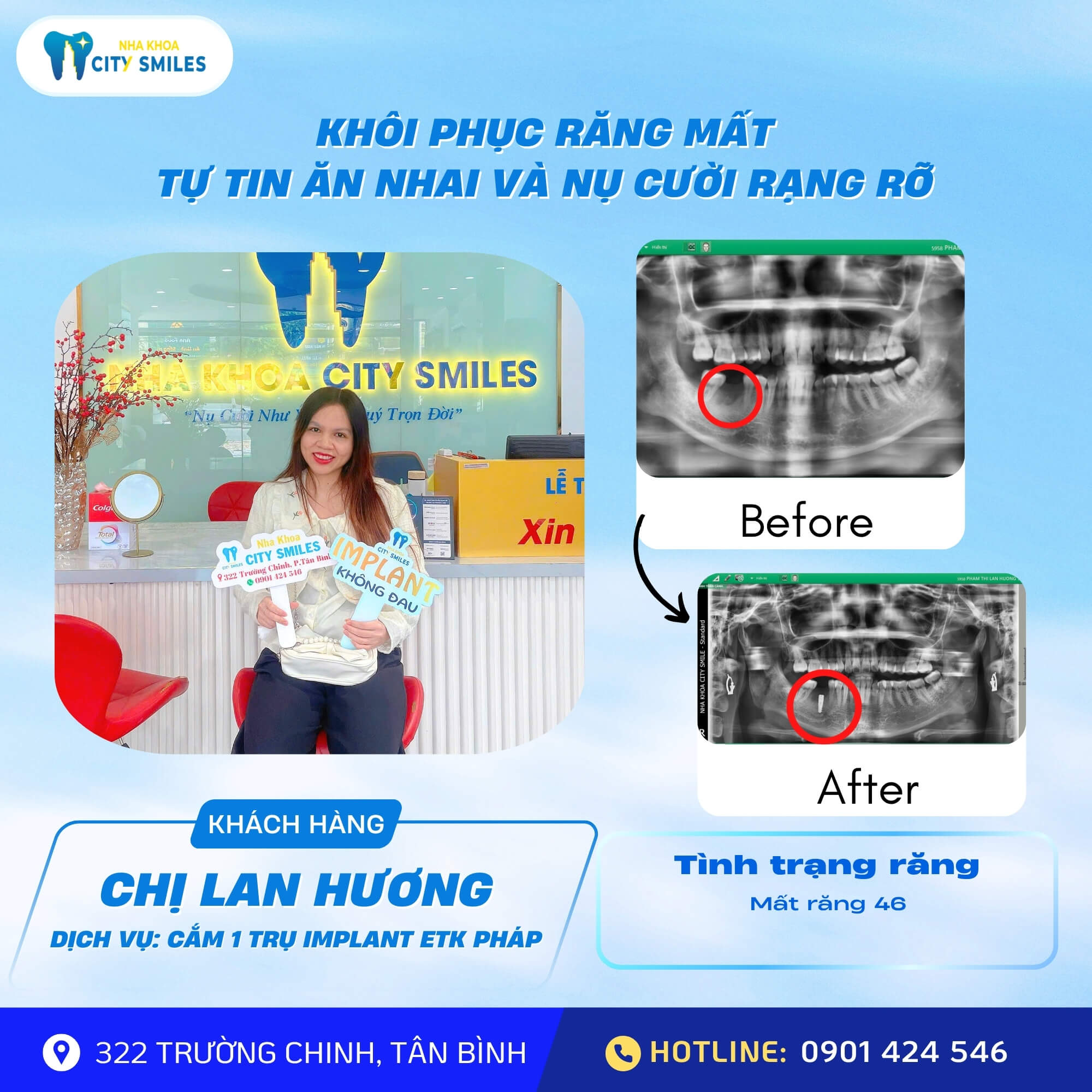 khoi-phuc-rang-mat-tu-tin-an-nhai-va-nu-cuoi-rang-ro