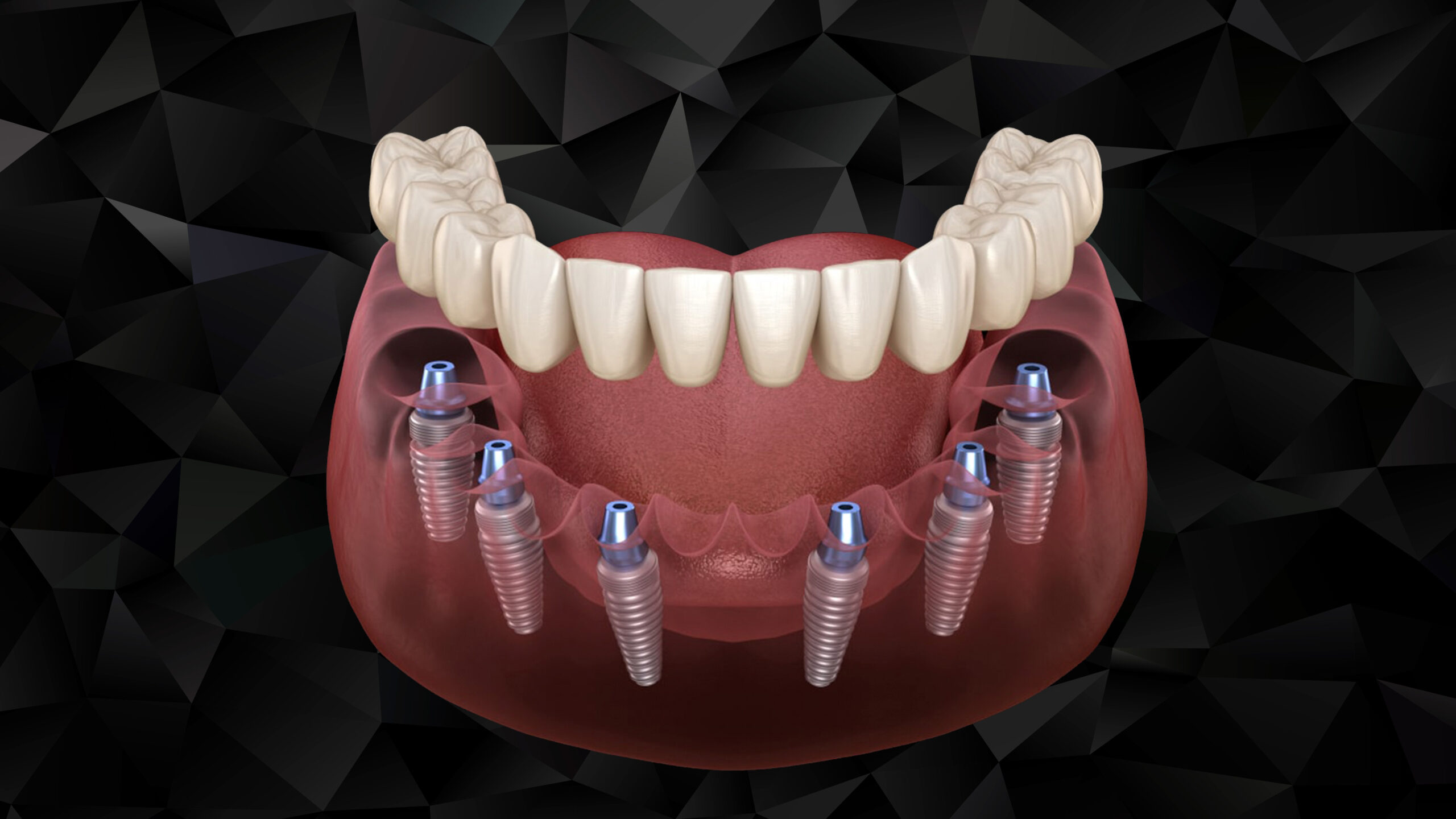 Trồng răng implant toàn hàm Tân Bình là giải pháp phục hình răng tối ưu cho người mất răng toàn bộ 3 Trồng răng Implant toàn hàm