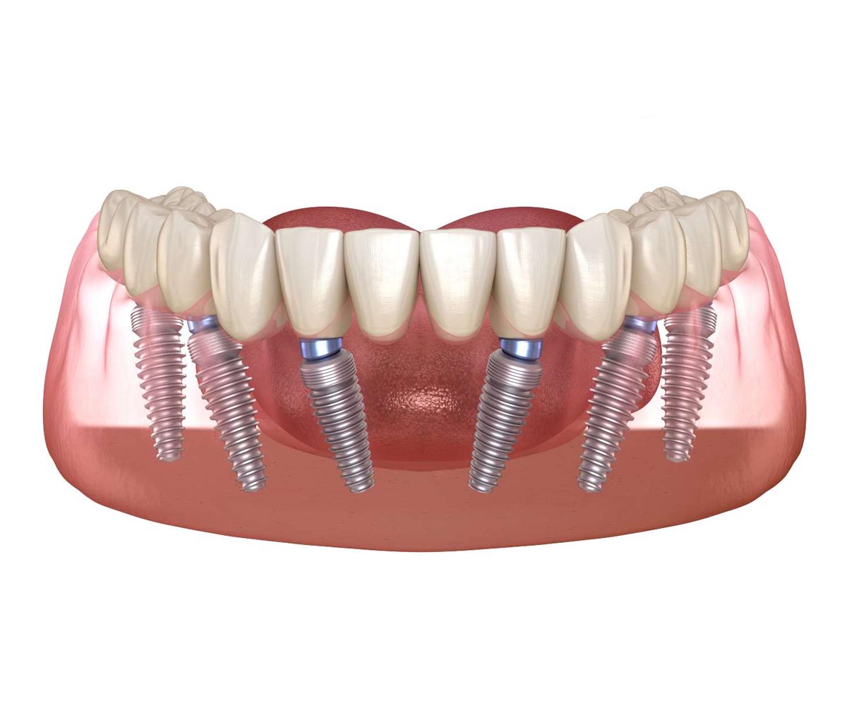 Trồng răng implant toàn hàm Tân Bình là giải pháp phục hình răng tối ưu cho người mất răng toàn bộ 5 Implant All on 6