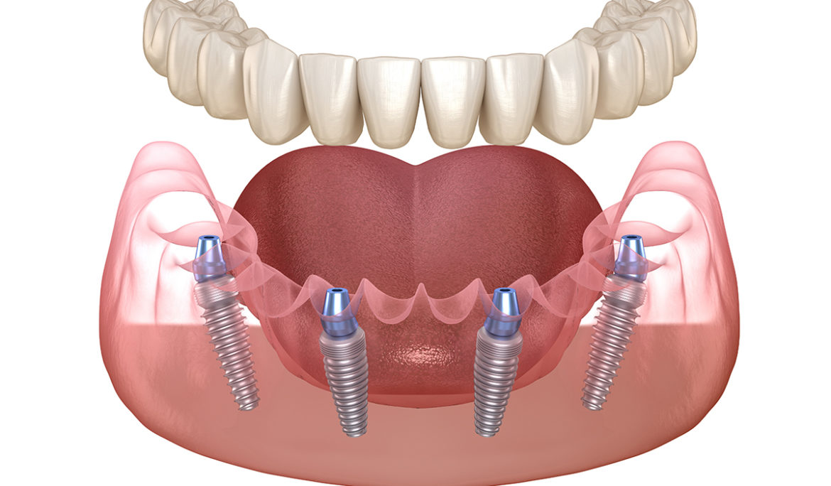 Trồng răng implant toàn hàm Tân Bình là giải pháp phục hình răng tối ưu cho người mất răng toàn bộ 4 Implant All on 4