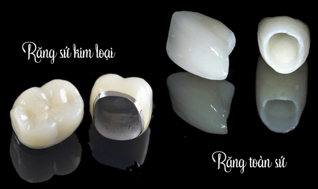 Làm Răng Sứ Là Gì? Quy Trình, Chi Phí Và Những Điều Cần Biết Trước Khi Làm Răng Sứ 7 Răng sứ kim loại và răng toàn sứ