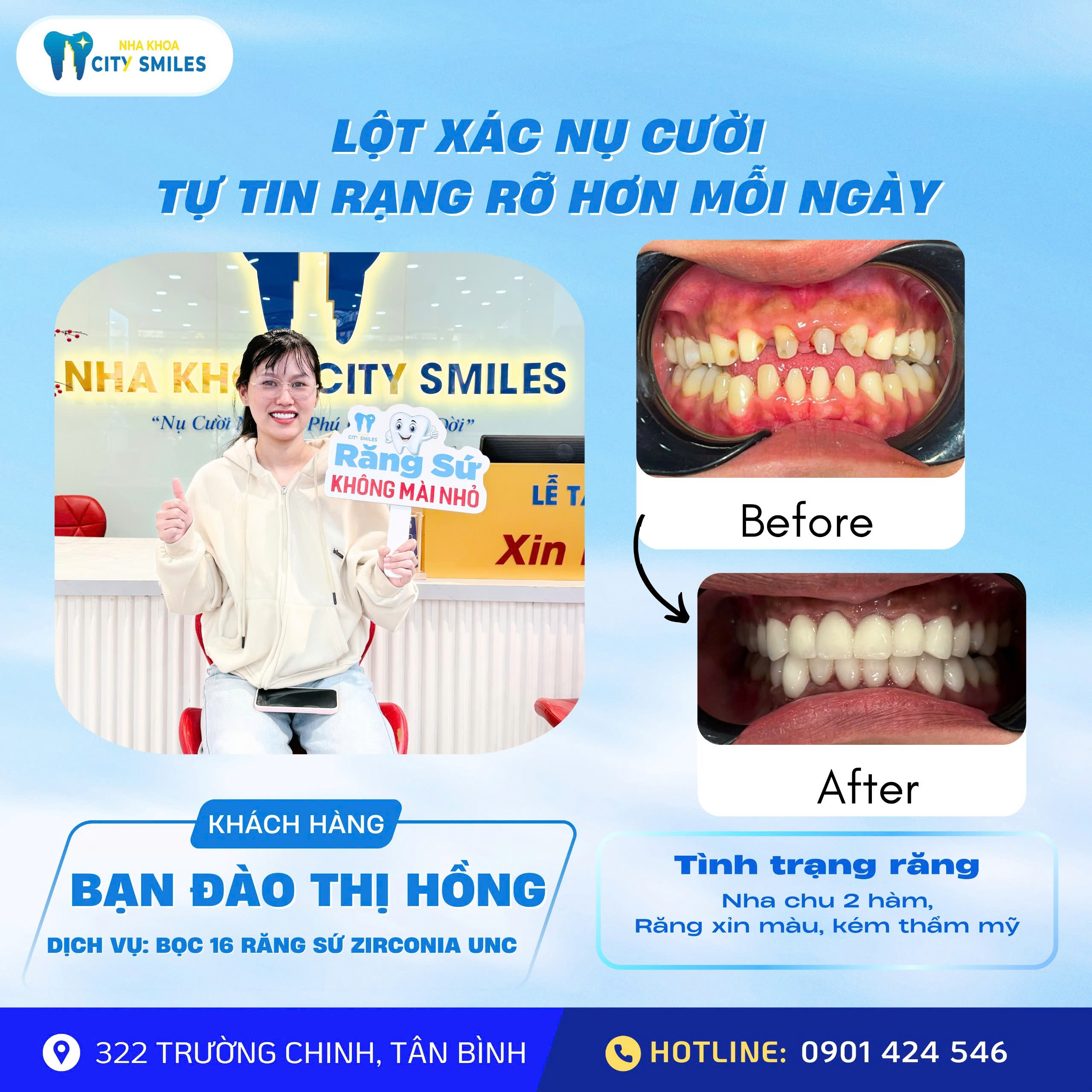 Làm Răng Sứ Là Gì? Quy Trình, Chi Phí Và Những Điều Cần Biết Trước Khi Làm Răng Sứ 9 Hình ảnh khách hàng rạng rỡ sau khi bọc răng sứ