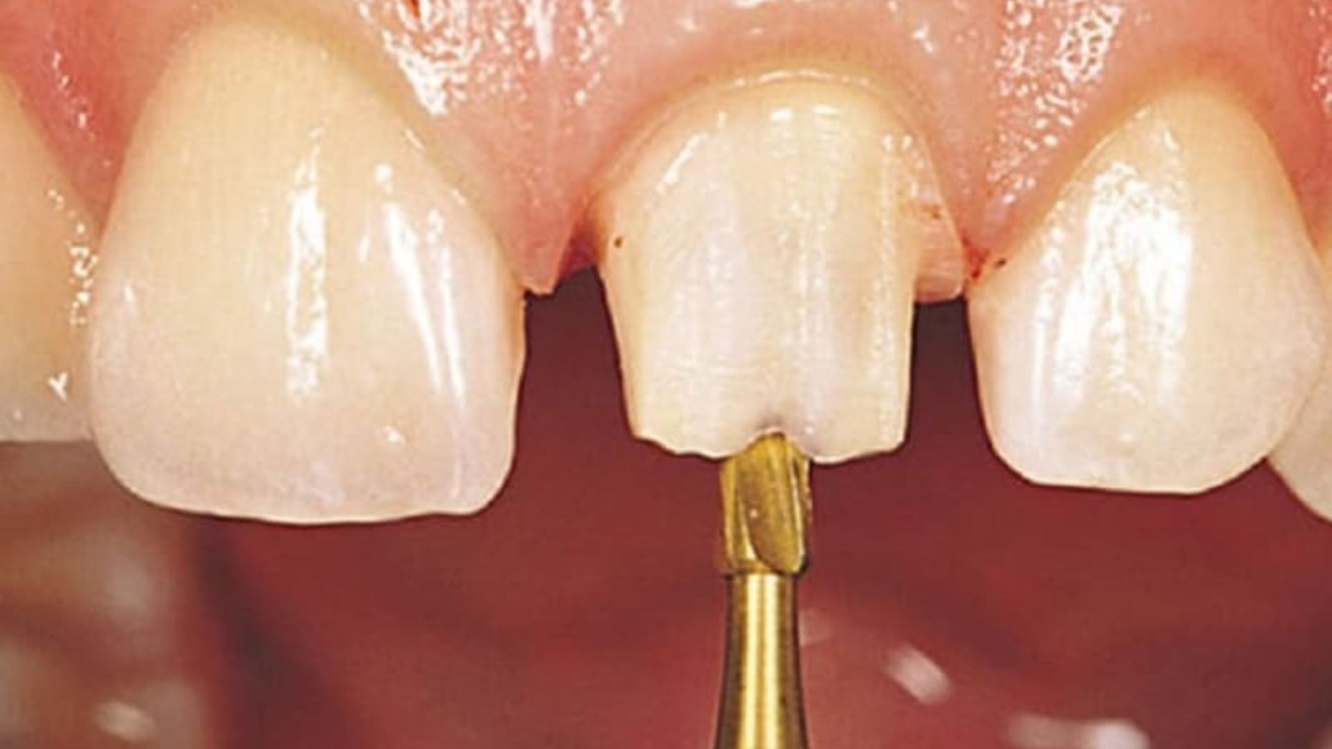 Kỹ thuật mài cùi răng tạo nhám bề mặt để chuẩn bị cho bước bọc răng sứ thẩm mỹ