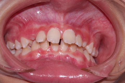 Tình trạng hô răng ở trẻ em cần được theo dõi & can thiệp sớm