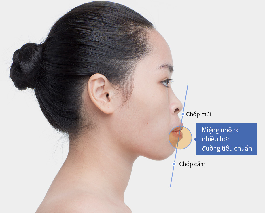 Tình trạng hô răng ảnh hưởng rất nhiều đến thẩm mỹ khuôn mặt