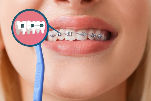 Tình trạng hô răng có thể sử dụng phương pháp chỉnh nha