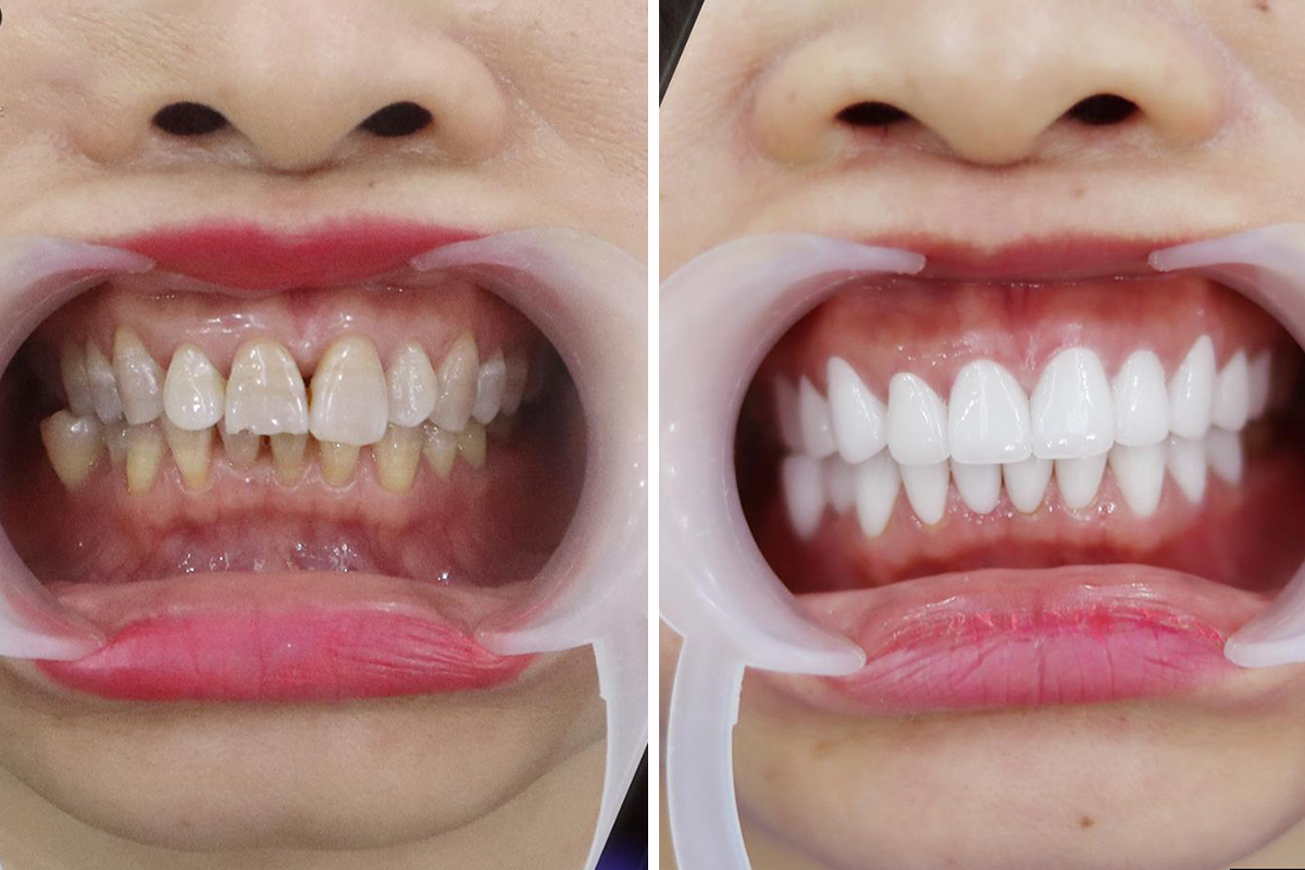 Răng hô nhẹ có thể bọc răng sứ 