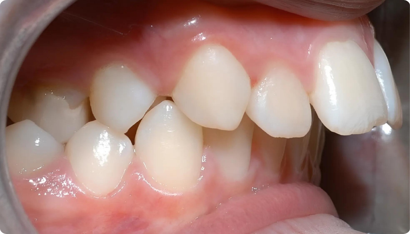 Răng hô do mắc bệnh lý về xương hàm rất phổ biến