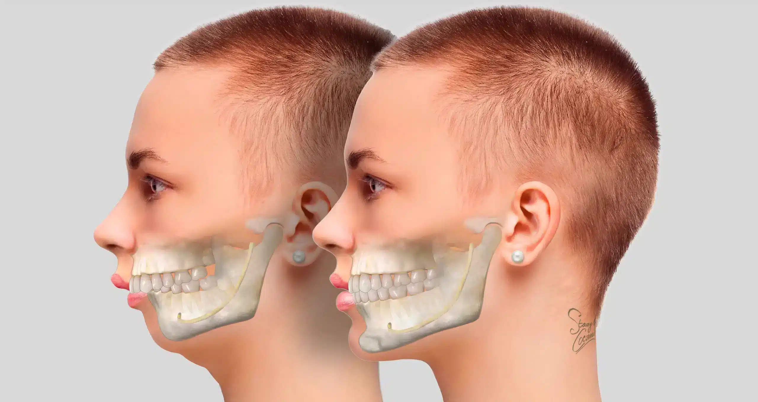 Tình trạng răng hô & răng bình thường