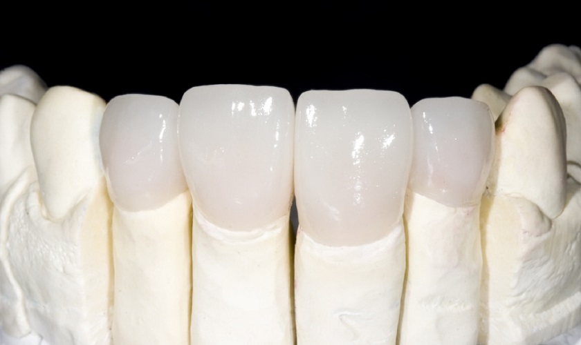 Răng sứ Zirconia đa lớp có độ trong mờ và vân răng tinh xảo, rất khó phân biệt với răng thật.