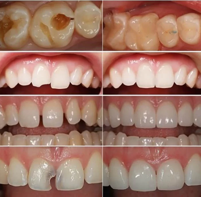 Tác Hại Của Việc Trám Răng Là Gì? 10 Biến Chứng Có Thể Gặp Và Cách Phòng Tránh 3 Các vị trí trám răng phổ biến