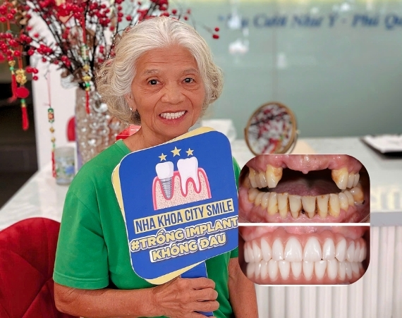 Trồng răng Implant mất bao lâu? Các giai đoạn phục hình 7 Trồng răng Implant mất bao lâu? Các giai đoạn phục hình 6