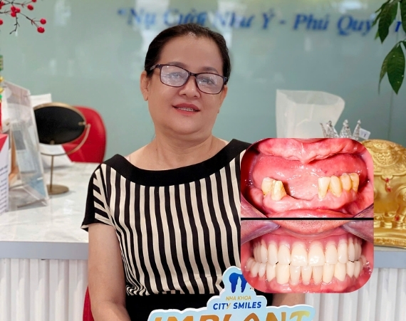 Implant toàn hàm là gì? Đối tượng, quy trình và chi phí 9 Implant toàn hàm là gì? Đối tượng, quy trình và chi phí 8