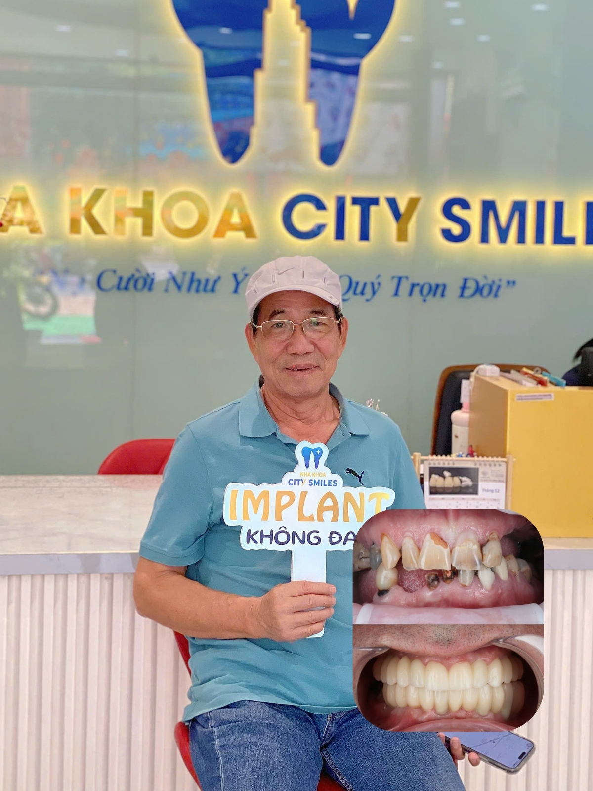 Mất răng có nên trồng Implant không? Không phải nha khoa nào cũng nói cho bạn điều này 8 Mất răng có nên trồng Implant không? Không phải nha khoa nào cũng nói cho bạn điều này 7