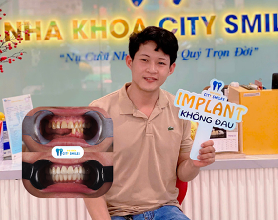 Trồng răng Implant mất bao lâu? Các giai đoạn phục hình 9 Trồng răng Implant mất bao lâu? Các giai đoạn phục hình 8