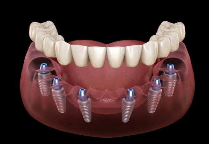 Trồng răng Implant toàn hàm