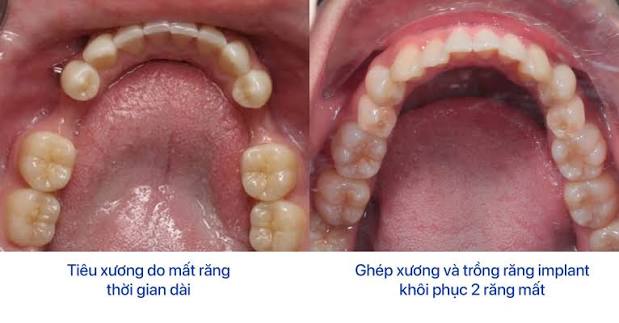Mất răng có nên trồng Implant không? Không phải nha khoa nào cũng nói cho bạn điều này 4 Tình trạng tiêu xương do mất răng lâu năm