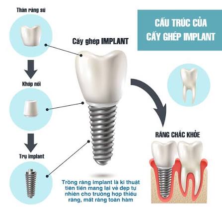 Mất răng có nên trồng Implant không? Không phải nha khoa nào cũng nói cho bạn điều này 5 Cấu trúc của cấy ghép Implant