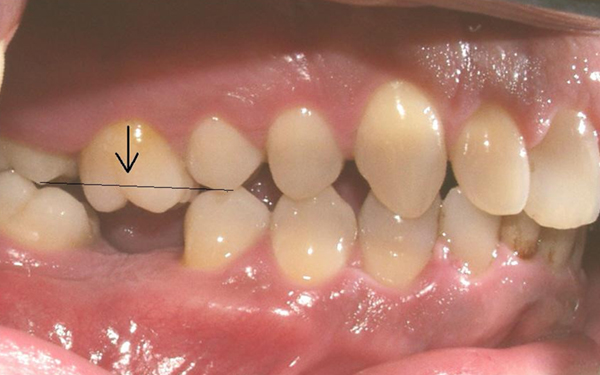 Trồng Implant răng số 6: Khi nào nên thực hiện? Quy trình và những điều cần lưu ý 5 Hậu quả khôn lường khi mất răng lâu năm