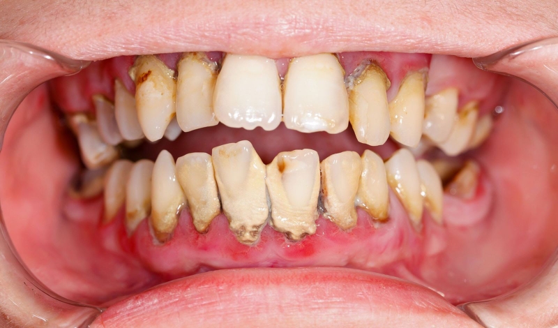 Trồng Implant răng số 6: Khi nào nên thực hiện? Quy trình và những điều cần lưu ý 6 Nếu bị viêm nha chu thì chưa thể trồng Implant ngay