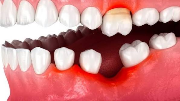 Trồng Implant răng số 6: Khi nào nên thực hiện? Quy trình và những điều cần lưu ý 3 Mất răng số 6
