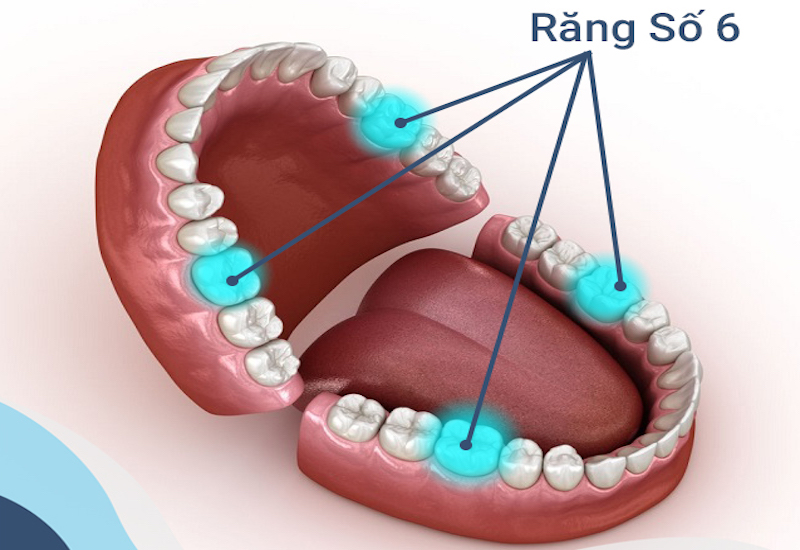 Trồng Implant răng số 6: Khi nào nên thực hiện? Quy trình và những điều cần lưu ý 2 Hình ảnh răng số 6