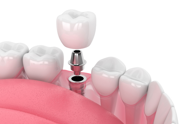 Trồng răng Implant răng số 6