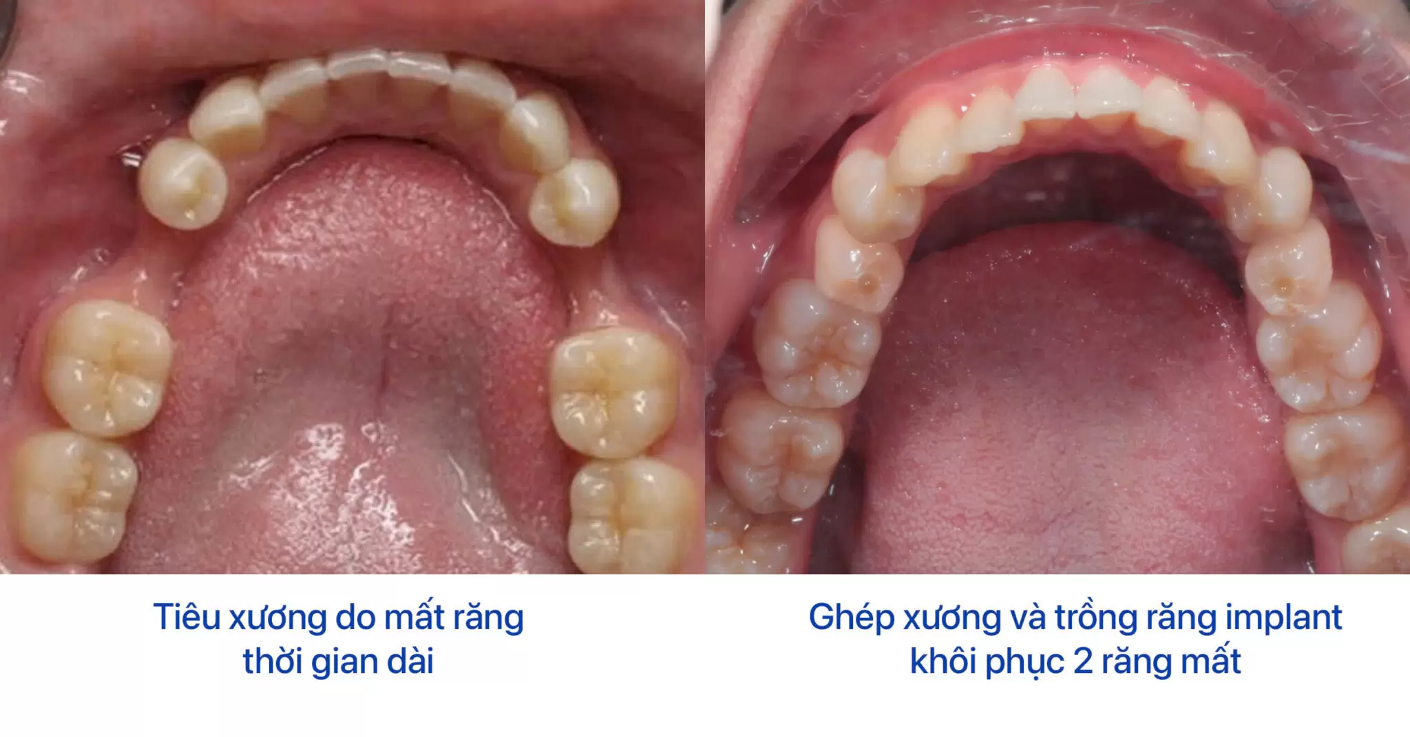 Trồng Implant răng số 6: Khi nào nên thực hiện? Quy trình và những điều cần lưu ý 4 Hình ảnh tiêu xương cho mất răng lâu năm
