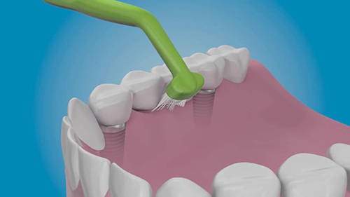Răng Implant cần được chăm sóc đúng cách