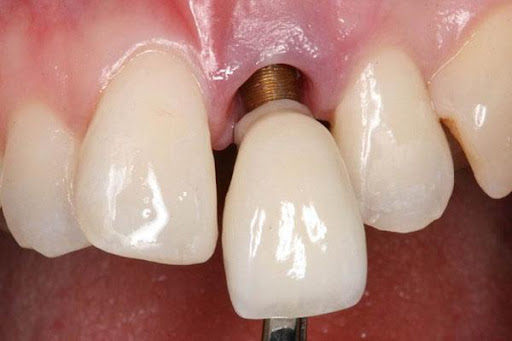 Trồng răng Implant có bền không? Tuổi thọ và cách chăm sóc 6 Implant bị bỏng sau lắp