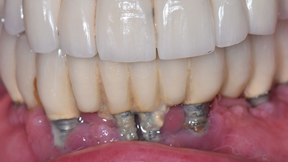 Trồng răng Implant có bền không? Tuổi thọ và cách chăm sóc 7 Tình trạng viêm quanh Implant