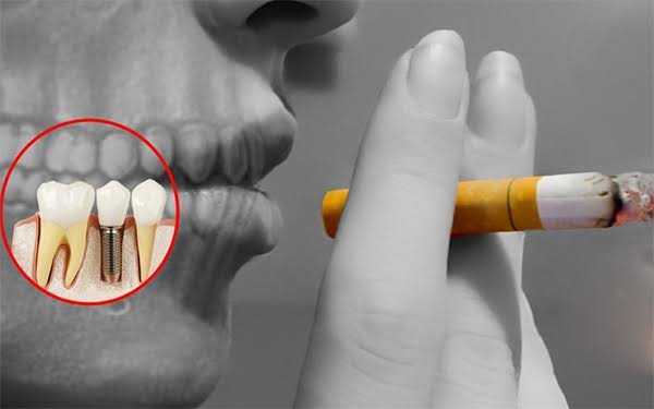 Trồng răng Implant có bền không? Tuổi thọ và cách chăm sóc 5 Không nên hút thuốc trong thời gian điều trị