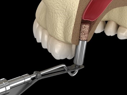 Trồng răng Implant có cần ghép xương không? Khi nào cần ghép xương? 4 Phương pháp nâng xoang trong cấy ghép Implant