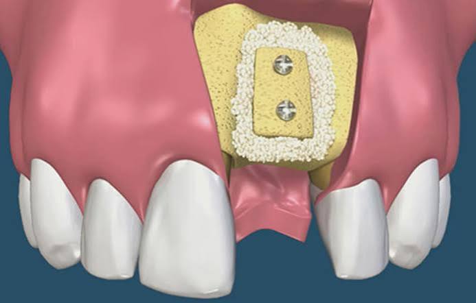 Trồng răng Implant có cần ghép xương không? Khi nào cần ghép xương?