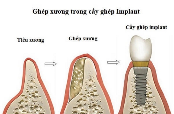 Trồng răng Implant có cần ghép xương không? Khi nào cần ghép xương? 3 Ghép xương trong cấy ghép implant