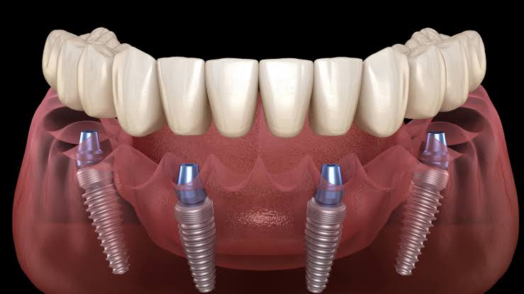 Trồng răng Implant có đau không? Mức độ đau và cách giảm đau 5 Trồng răng Implant có đau không? Mức độ đau và cách giảm đau 4