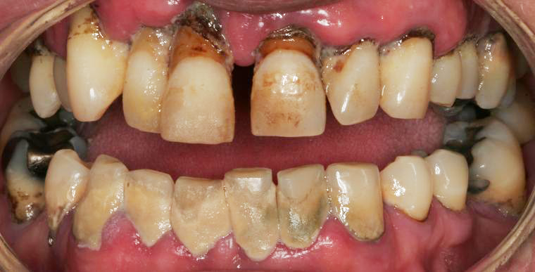 Trồng răng Implant có đau không? Mức độ đau và cách giảm đau 9 Trồng răng Implant có đau không? Mức độ đau và cách giảm đau 8