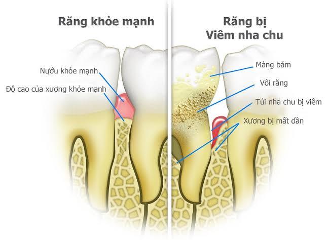 Trồng răng Implant có đau không? Mức độ đau và cách giảm đau 11 Trồng răng Implant có đau không? Mức độ đau và cách giảm đau 10