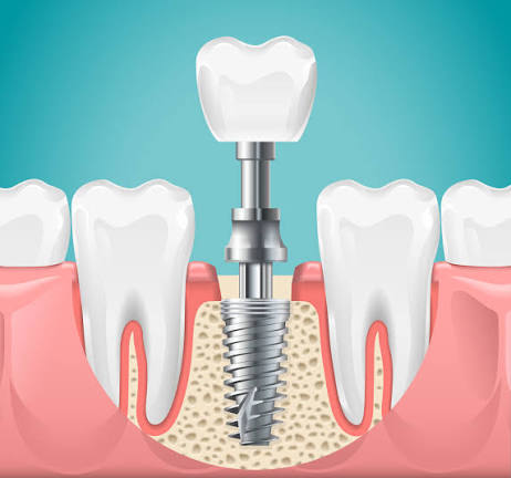 Trồng răng Implant có đau không? Mức độ đau và cách giảm đau 1