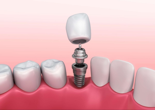 Trồng răng Implant giá bao nhiêu? Chi phí gồm những gì và có phát sinh không? 1